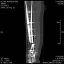 November 2008 CT - increased pain, swelling, redness, fever.jpg