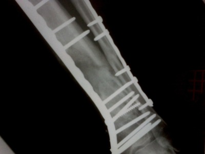 June 9, 2009 - 6 weeks post second internal fixation and autograft.jpg