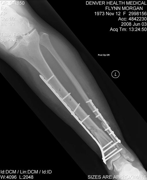June 3, 2008 - first internal fixation AP.jpg