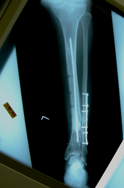 March 12, 2009 - methylmethacrylate-vancomycin and rod in place.JPG